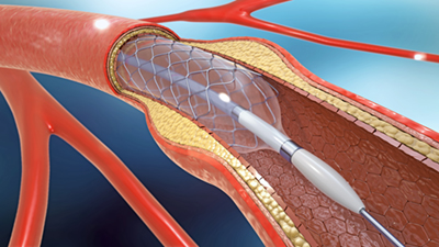 3d illustration of stent implantation for supporting blood circu 3d illustration of stent implantation for supporting blood circulation into blood vessels