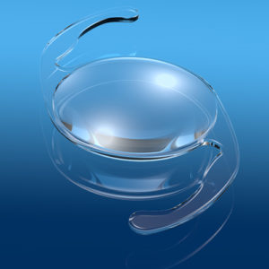 Medically illustration showing intraocular lens (IOL), a lens implanted in the eye as part of a treatment for cataracts or myopia